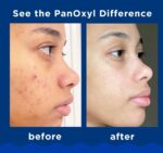 PanOxyl Acne Foaming Wash Benzoyl Peroxide 10% Maximum Strength.